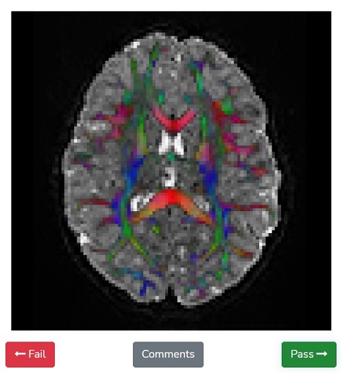 Help the Fibr Algorithm Learn to Read MRI Scans