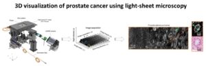 3D Visualization of Prostate Cancer Using Light-Sheet Microscopy