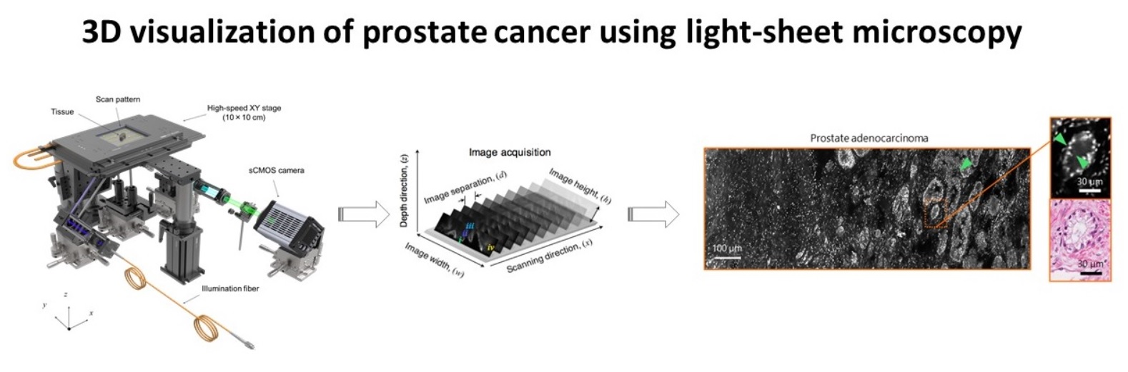 3D Visualization of Prostate Cancer Using Light-Sheet Microscopy